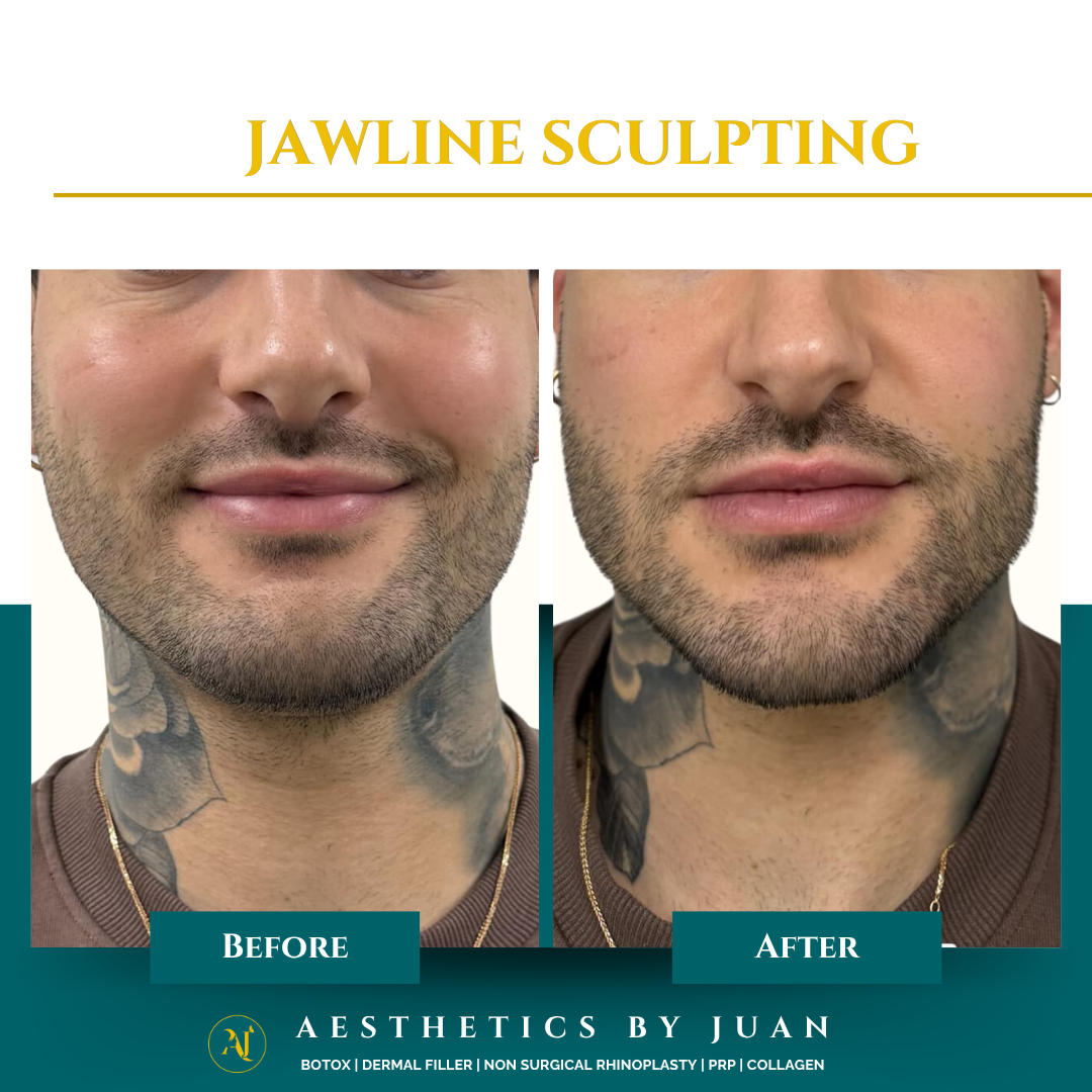 Jawline sculpting before and after result