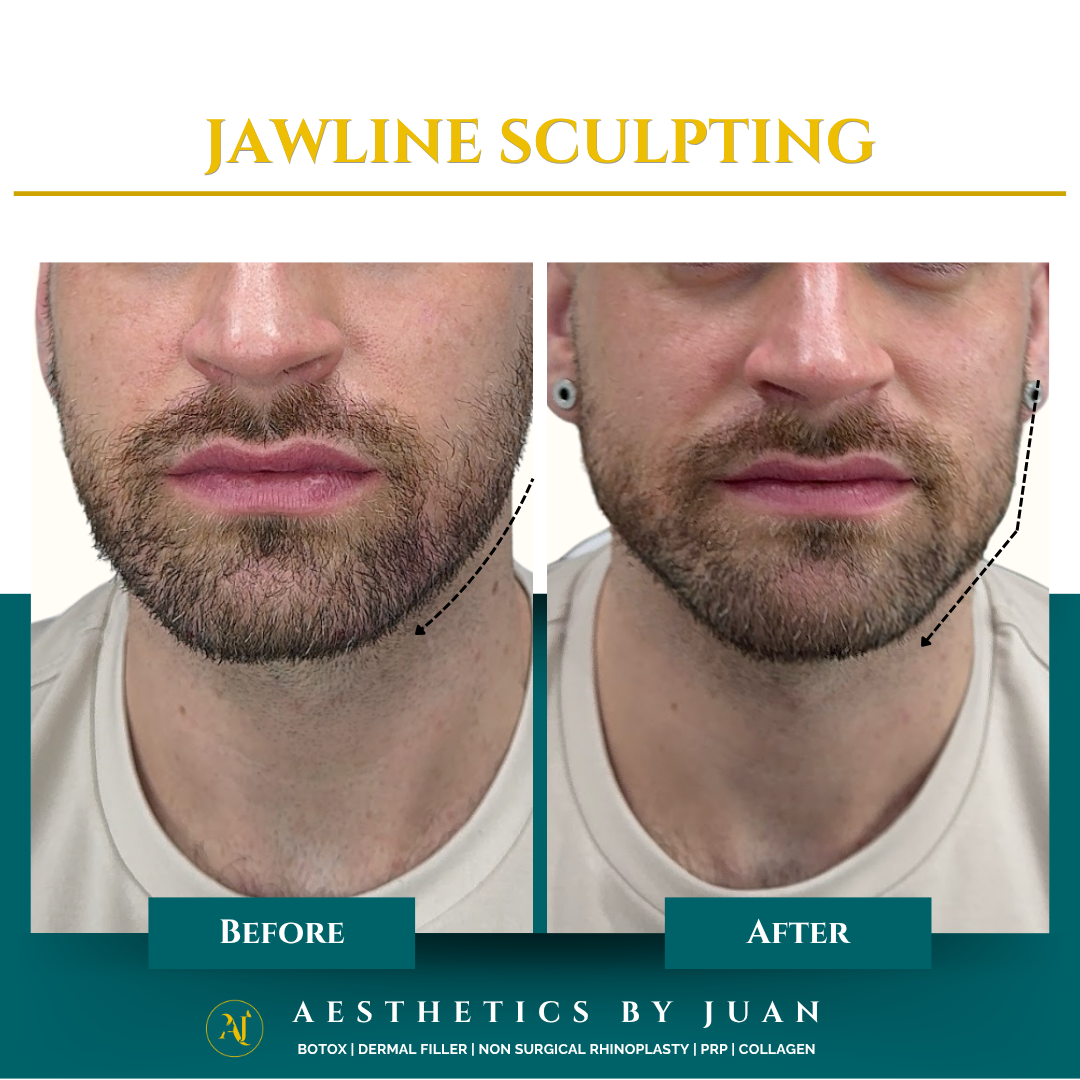 Jawline sculpting before and after result
