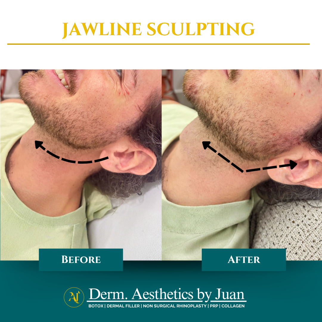 Jawline sculpting before and after result