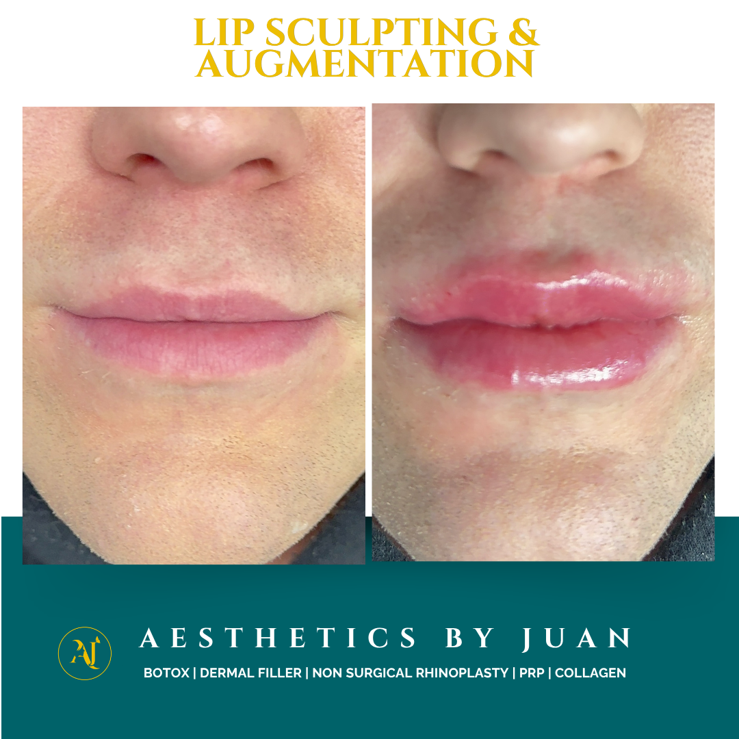 Lip sculpting and augmentation before and after result