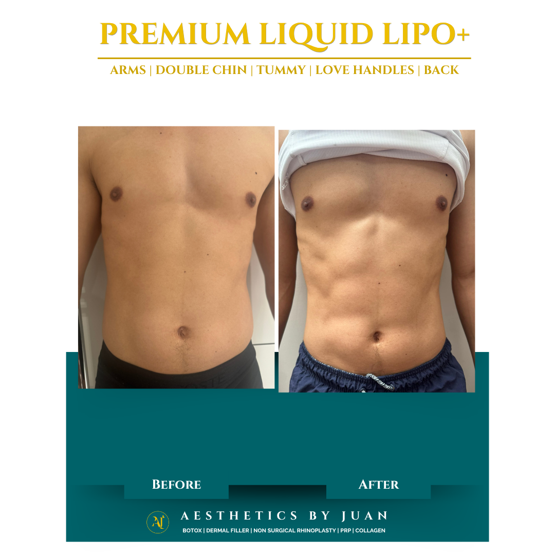 Premium liquid lipo before and after result