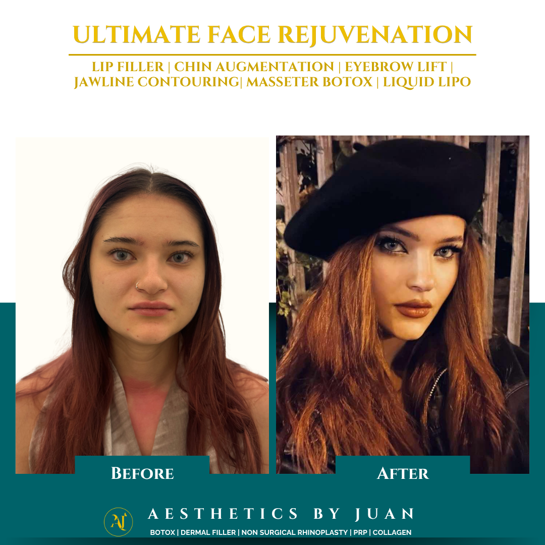 Ultimate face rejuvenation before and after result
