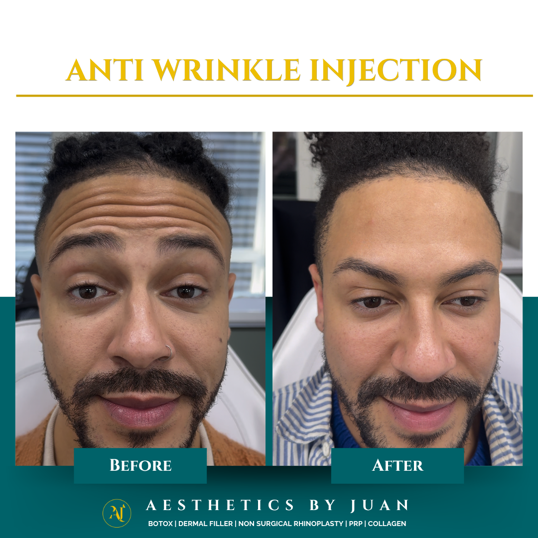 Anti-wrinkle injection before and after result