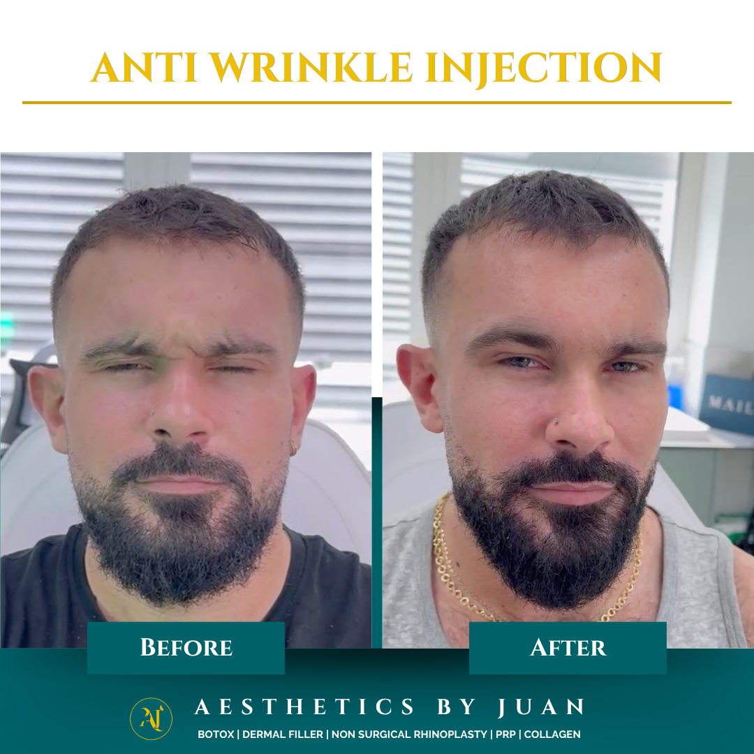 Anti-wrinkle injection before and after result
