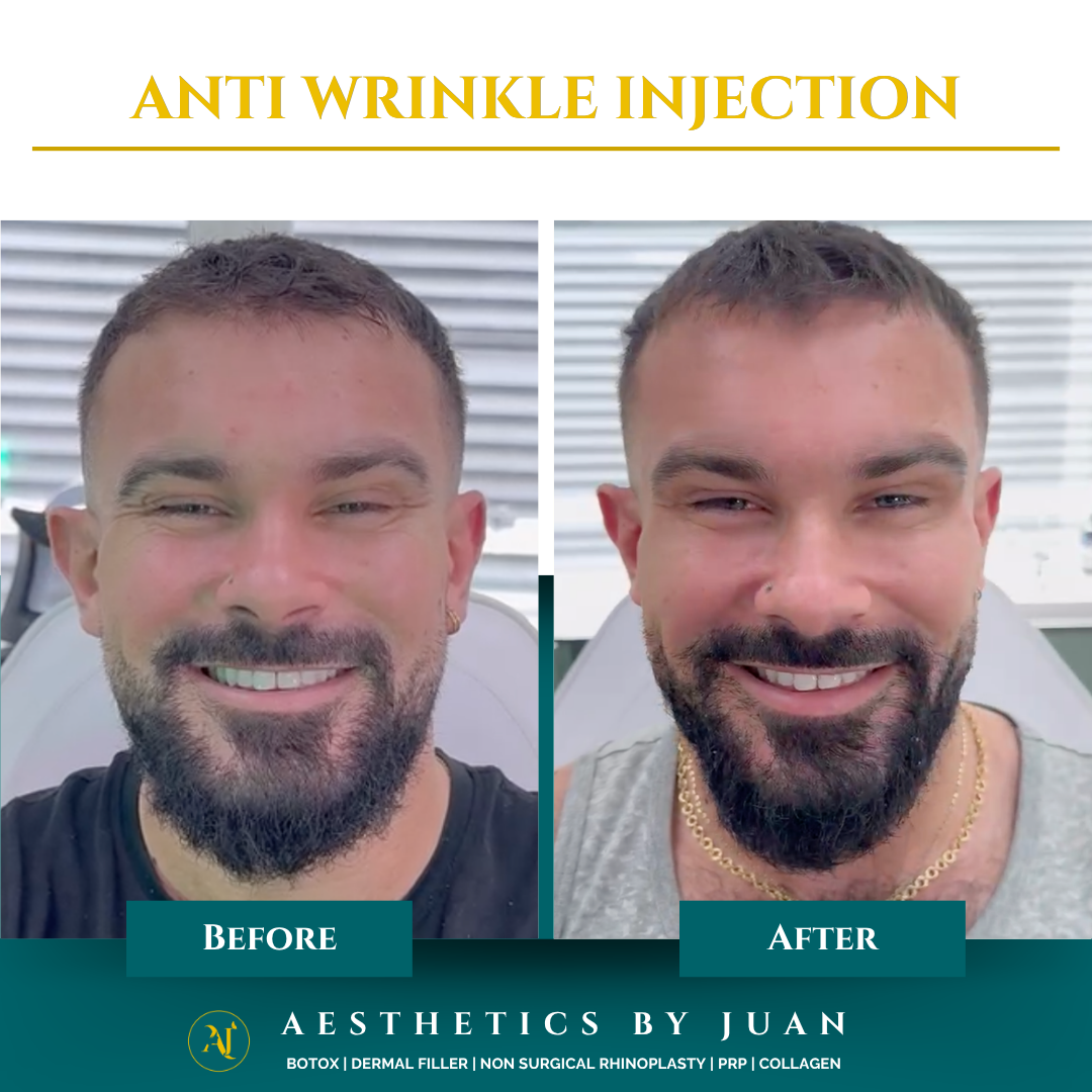 Anti-wrinkle injection before and after result