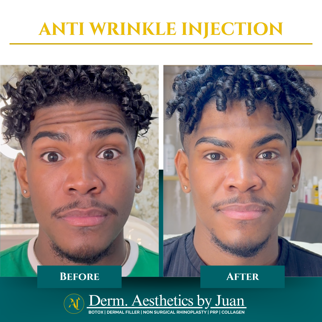 Anti-wrinkle injection before and after result