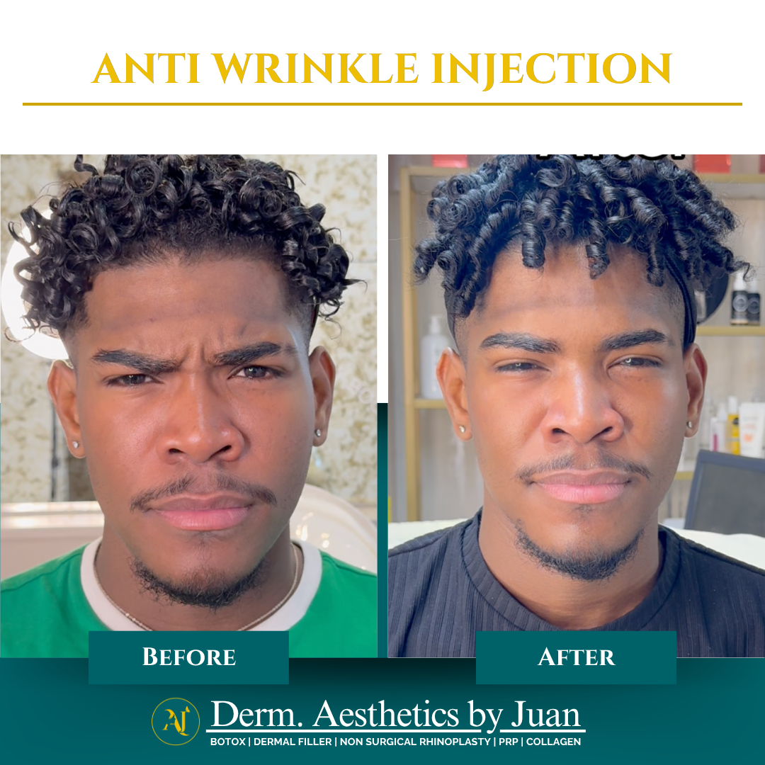 Anti-wrinkle injection before and after result