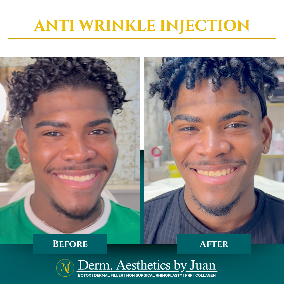 Anti-wrinkle injection before and after result