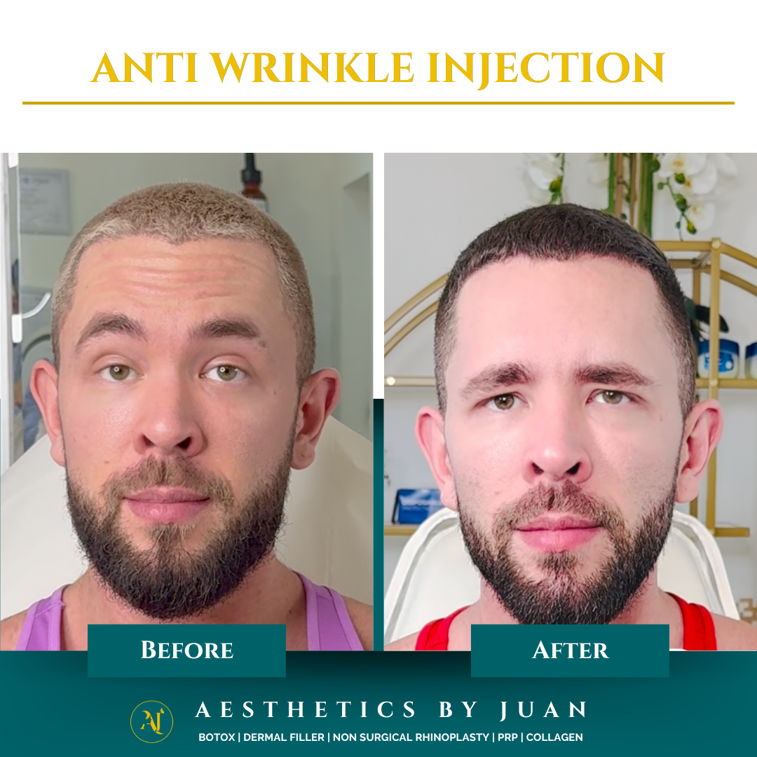 Anti-wrinkle injection before and after result