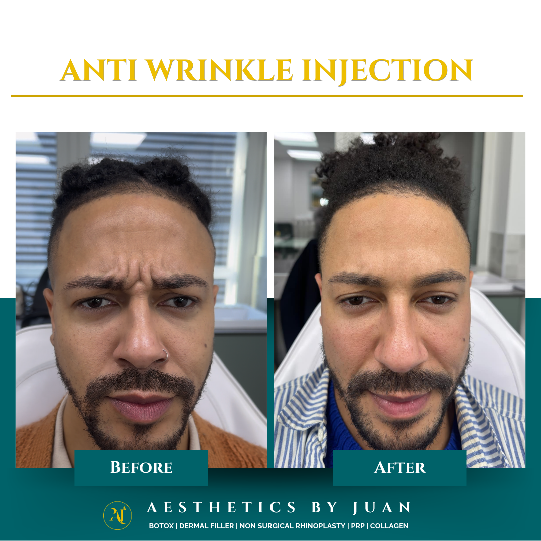 Anti-wrinkle injection before and after result