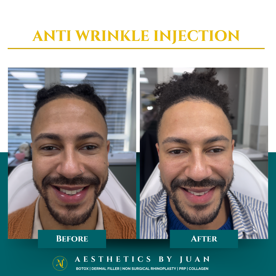 Anti-wrinkle injection before and after result