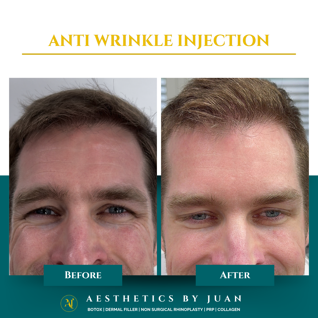 Anti-wrinkle injection before and after result