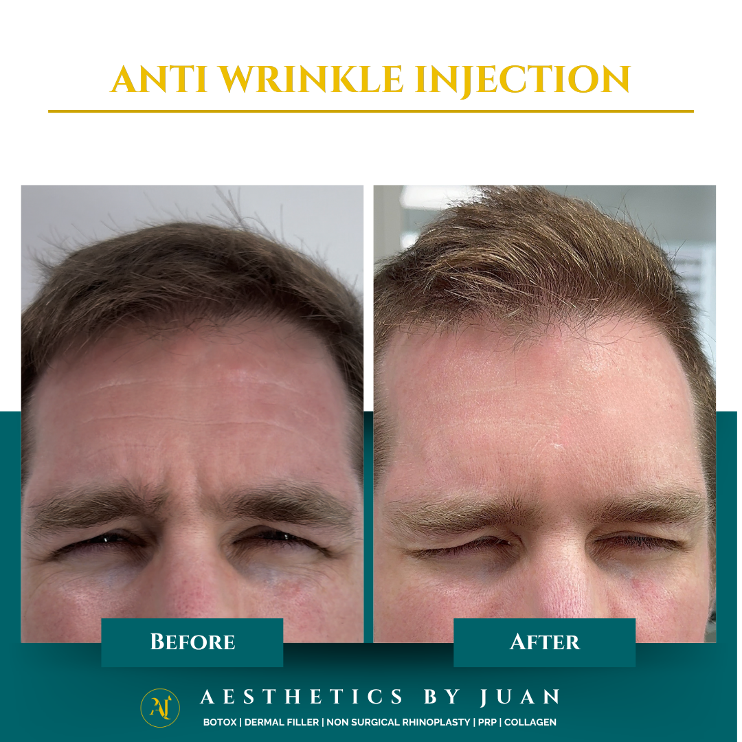 Anti-wrinkle injection before and after result