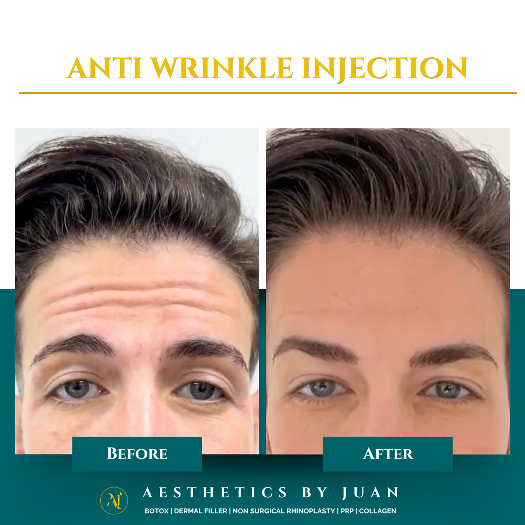Anti-wrinkle injection before and after result