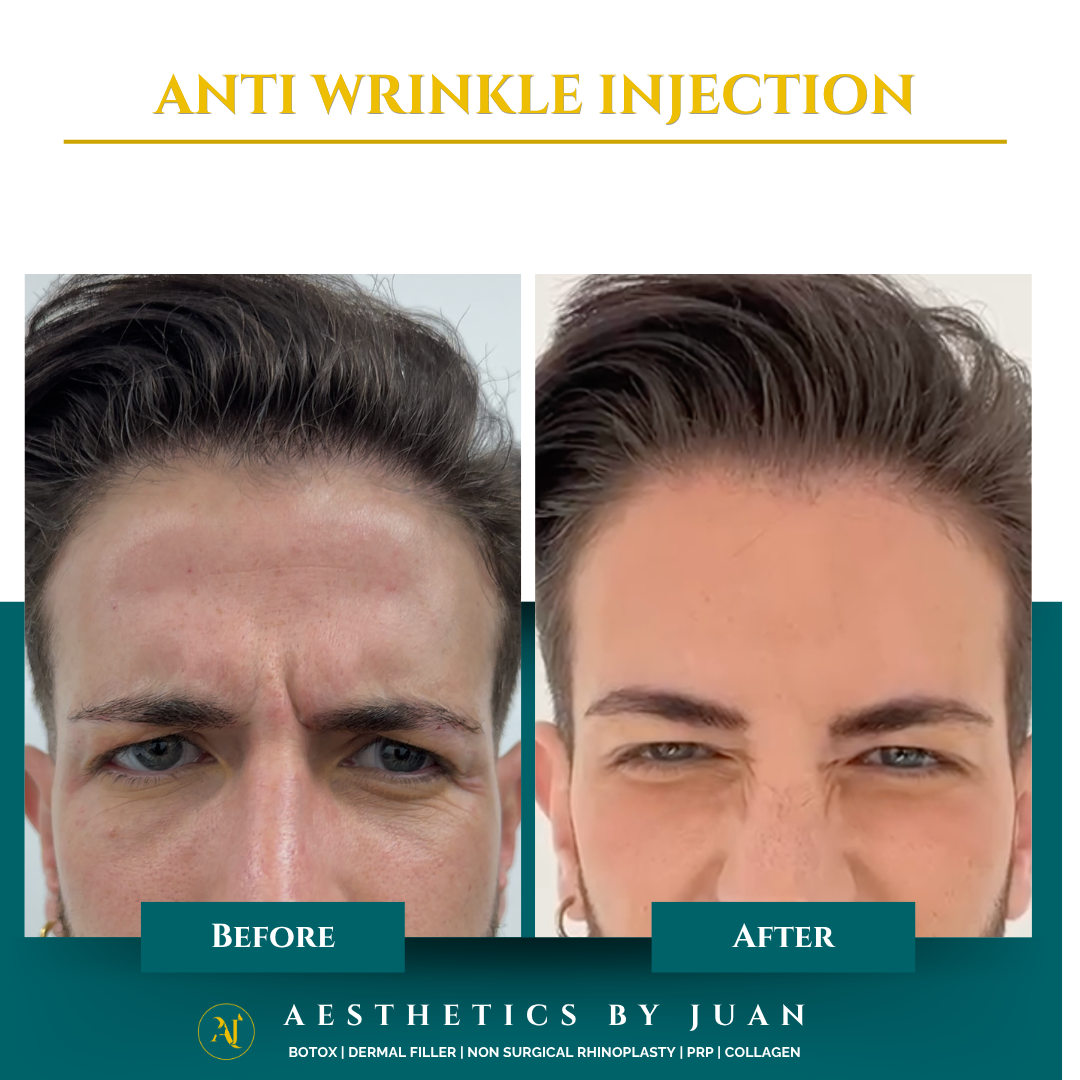 Anti-wrinkle injection before and after result