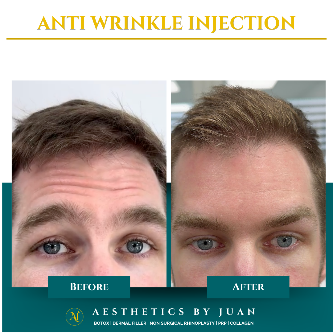Anti-wrinkle injection before and after result