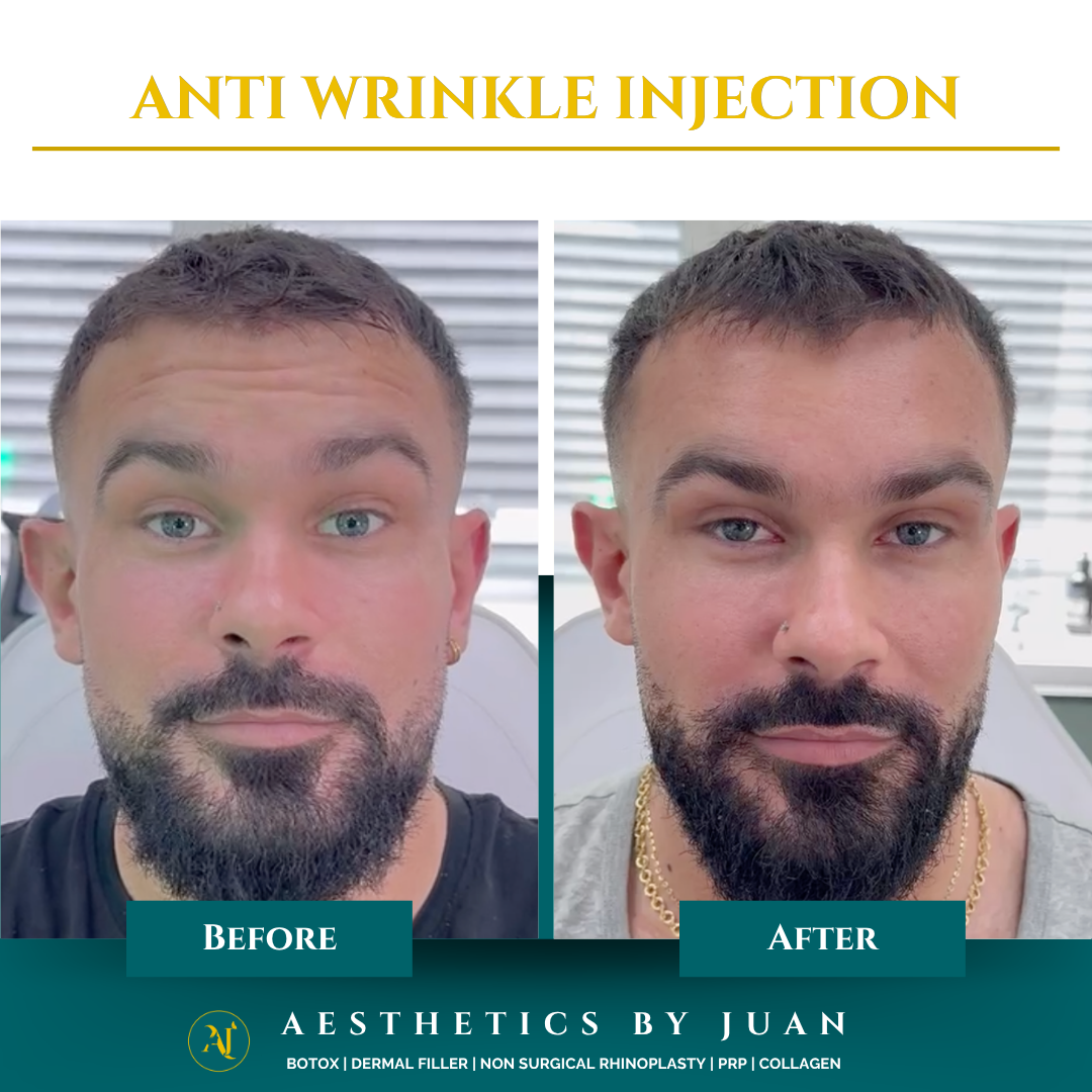 Anti-wrinkle injection before and after result