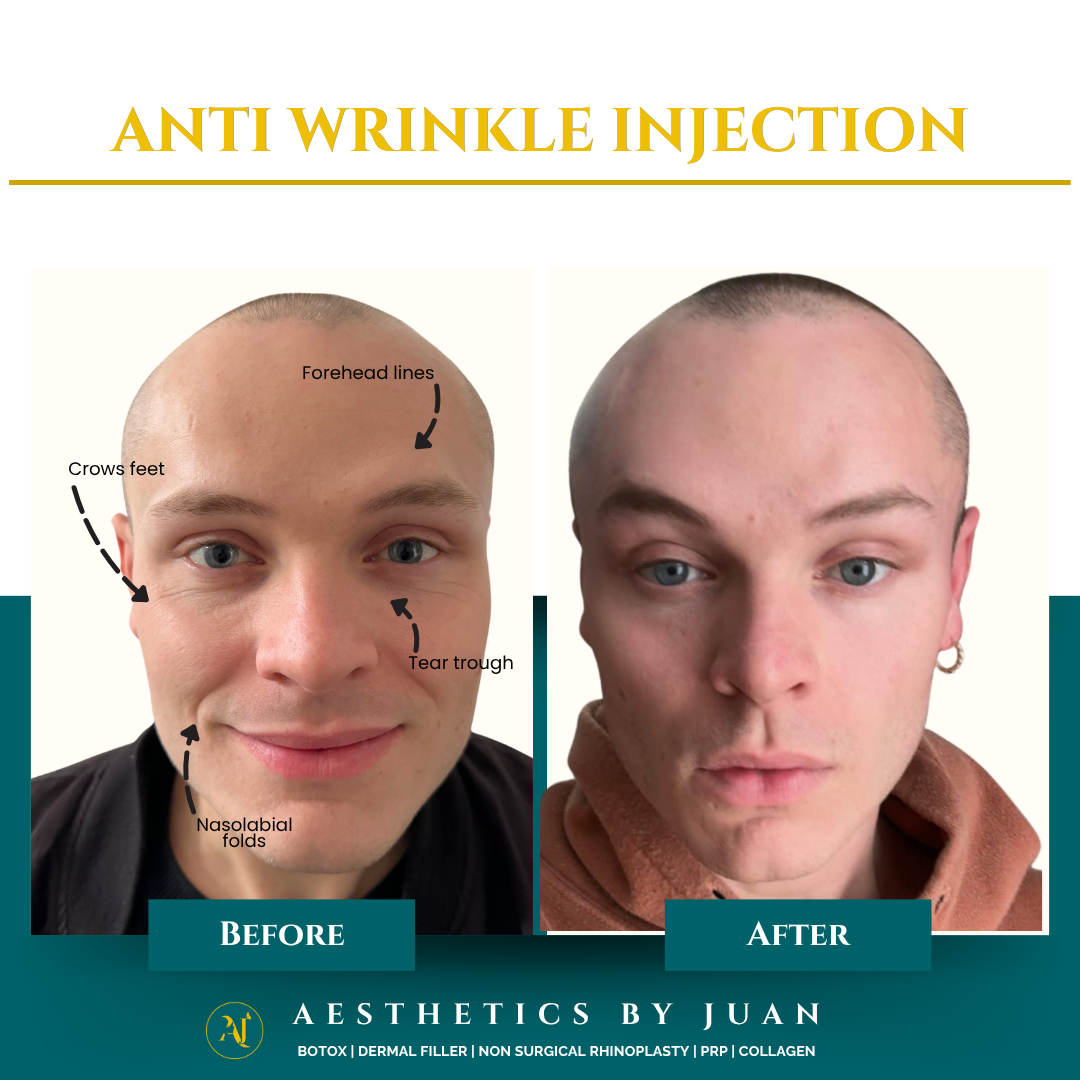 Anti-wrinkle injection before and after result