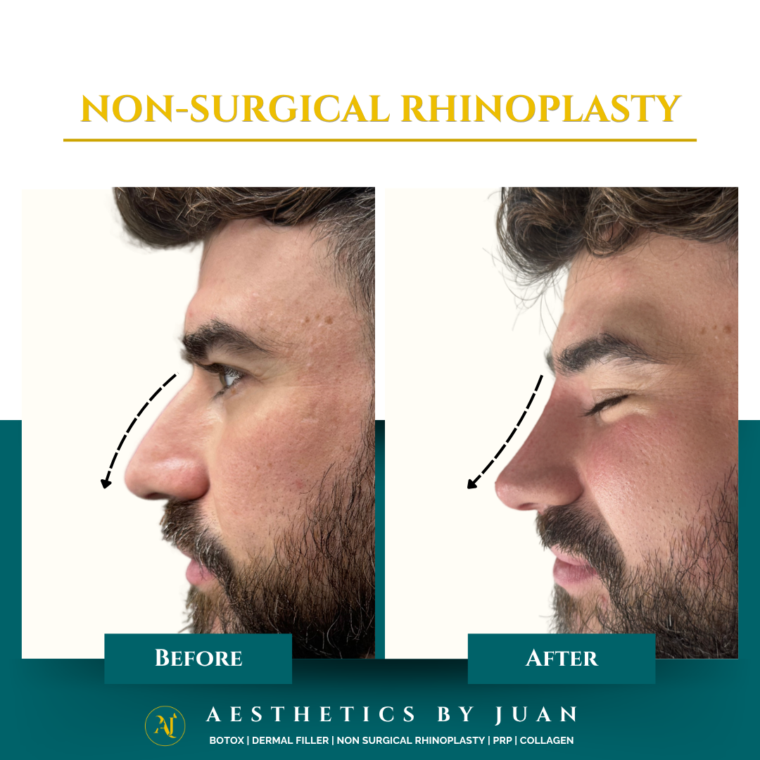 Non-surgical rhinoplasty before and after result