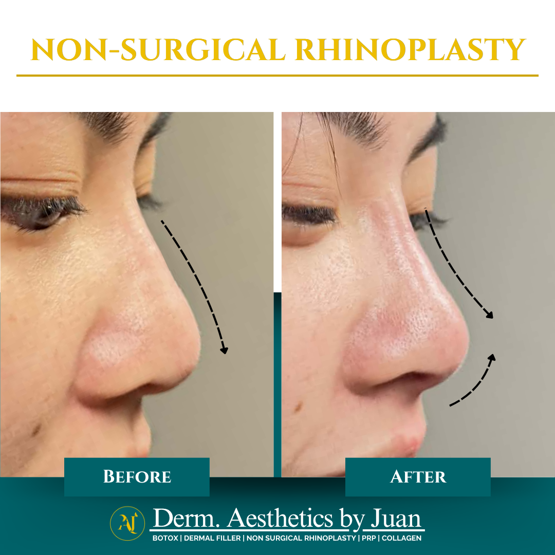 Non-surgical rhinoplasty before and after result