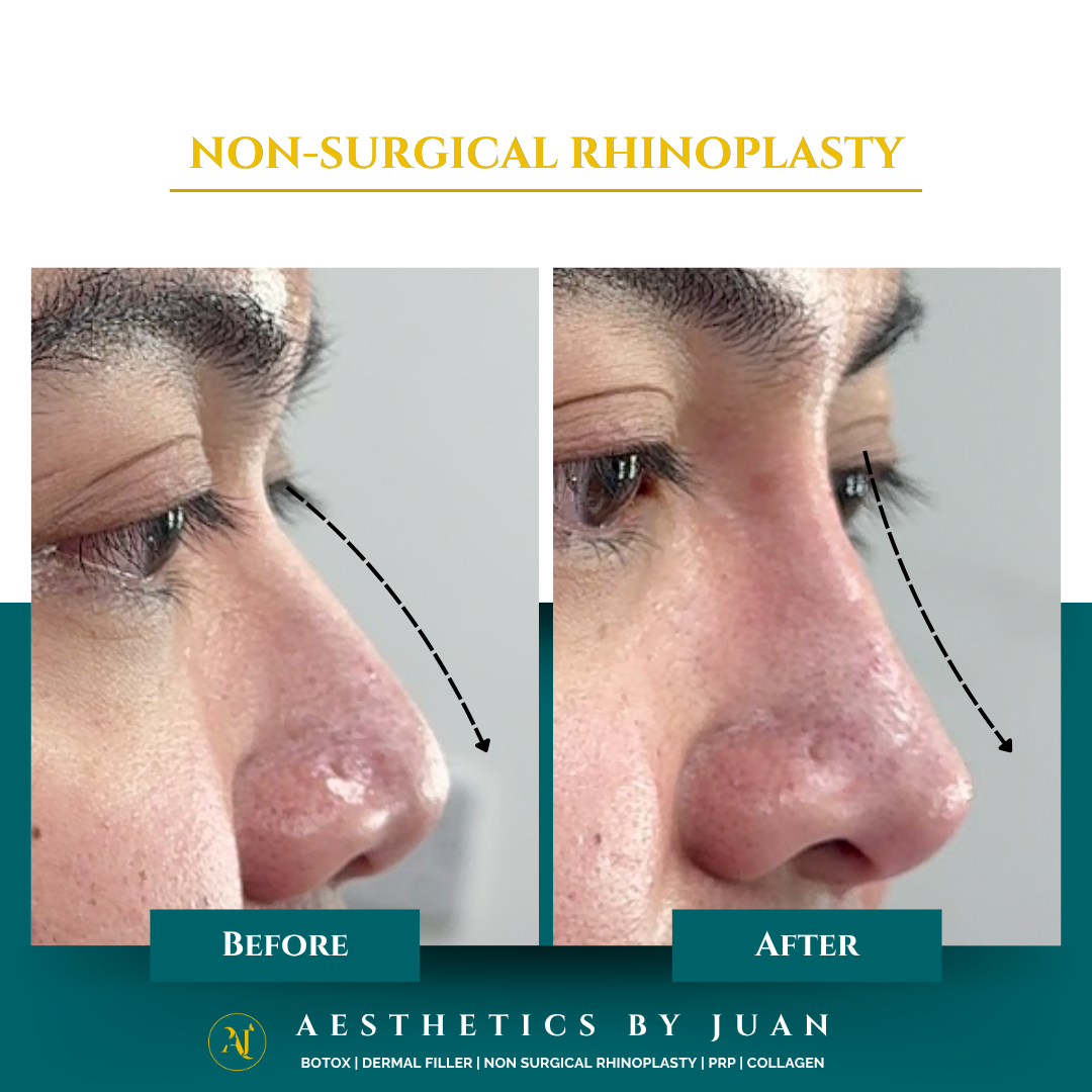 Non-surgical rhinoplasty before and after result