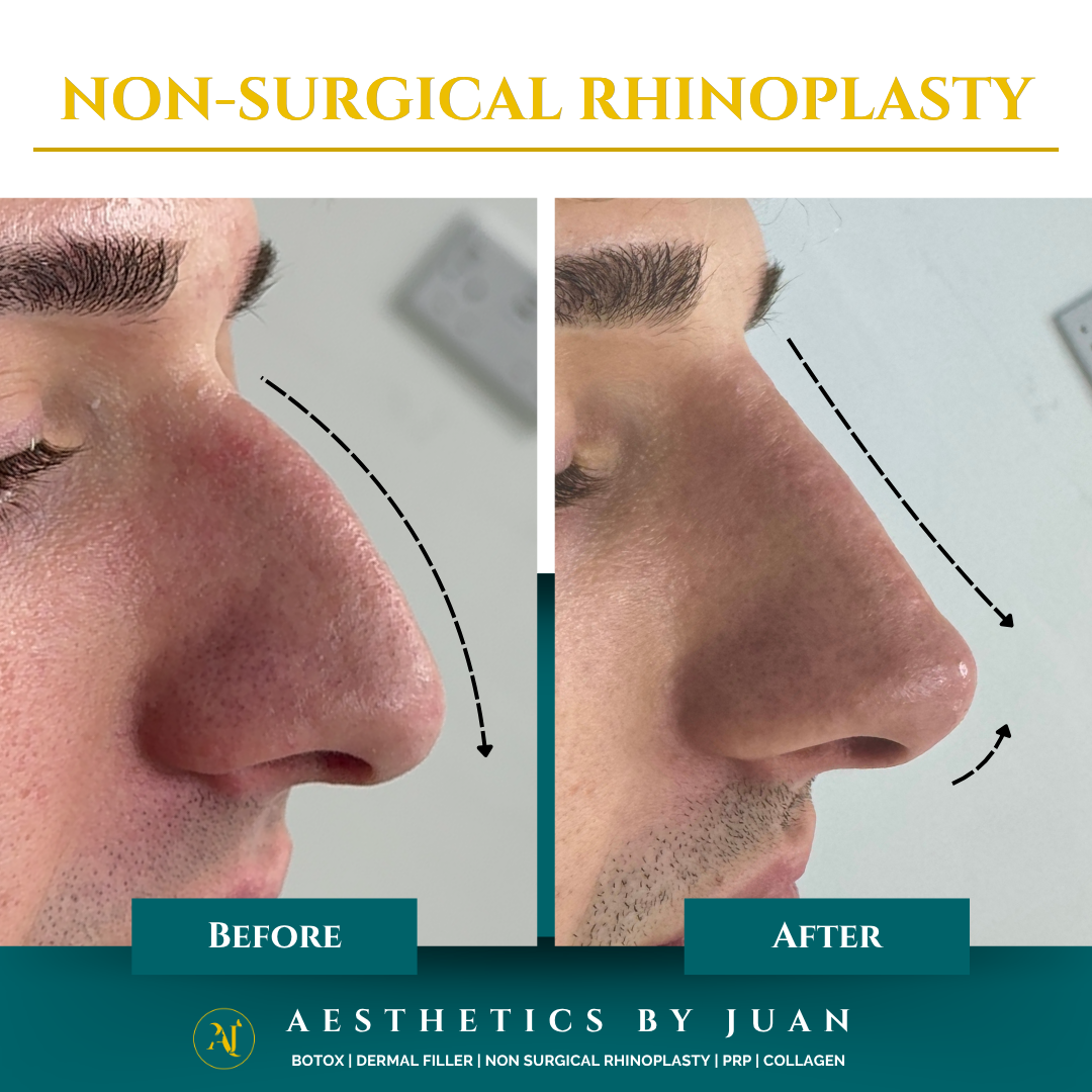 Non-surgical rhinoplasty before and after result