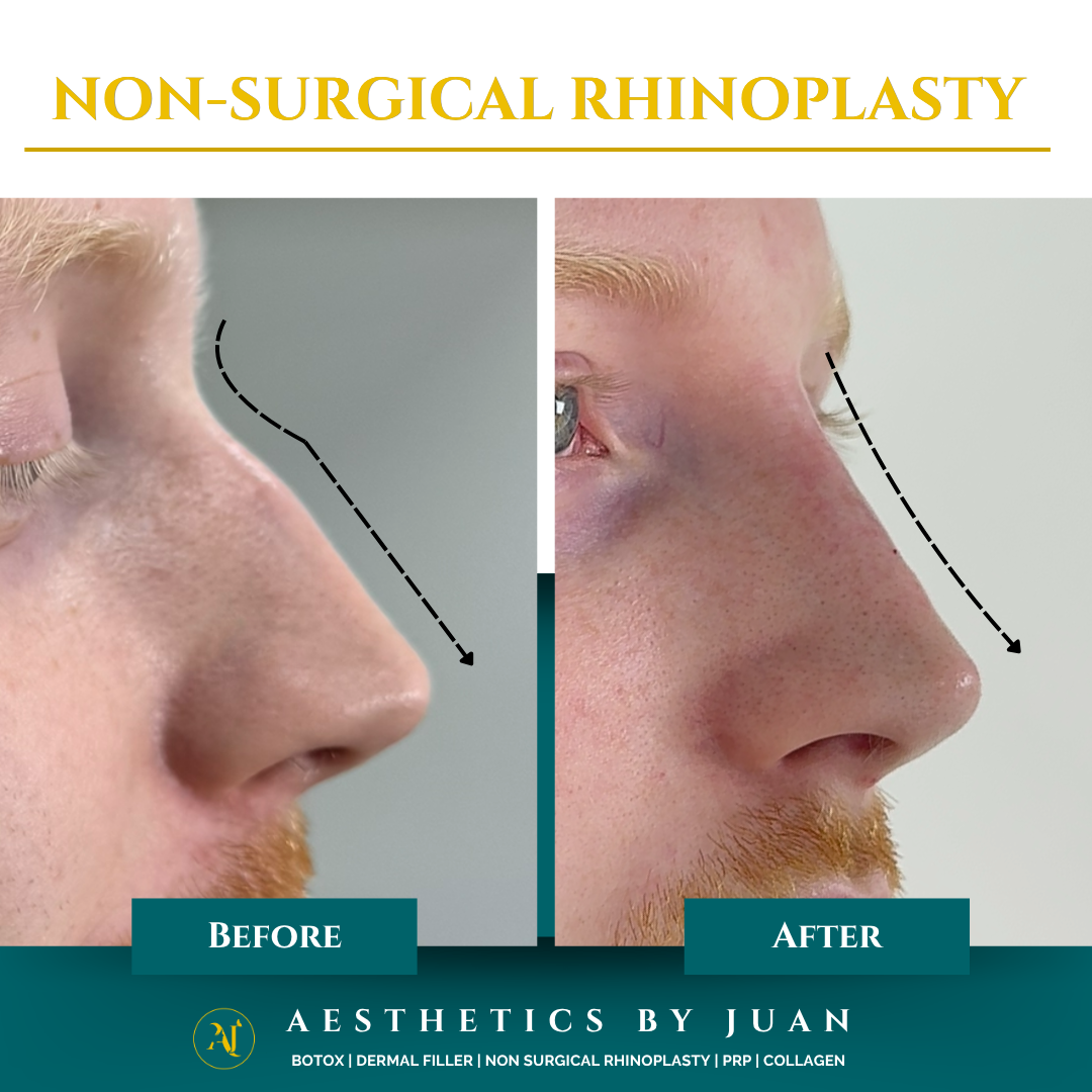 Non-surgical rhinoplasty before and after result