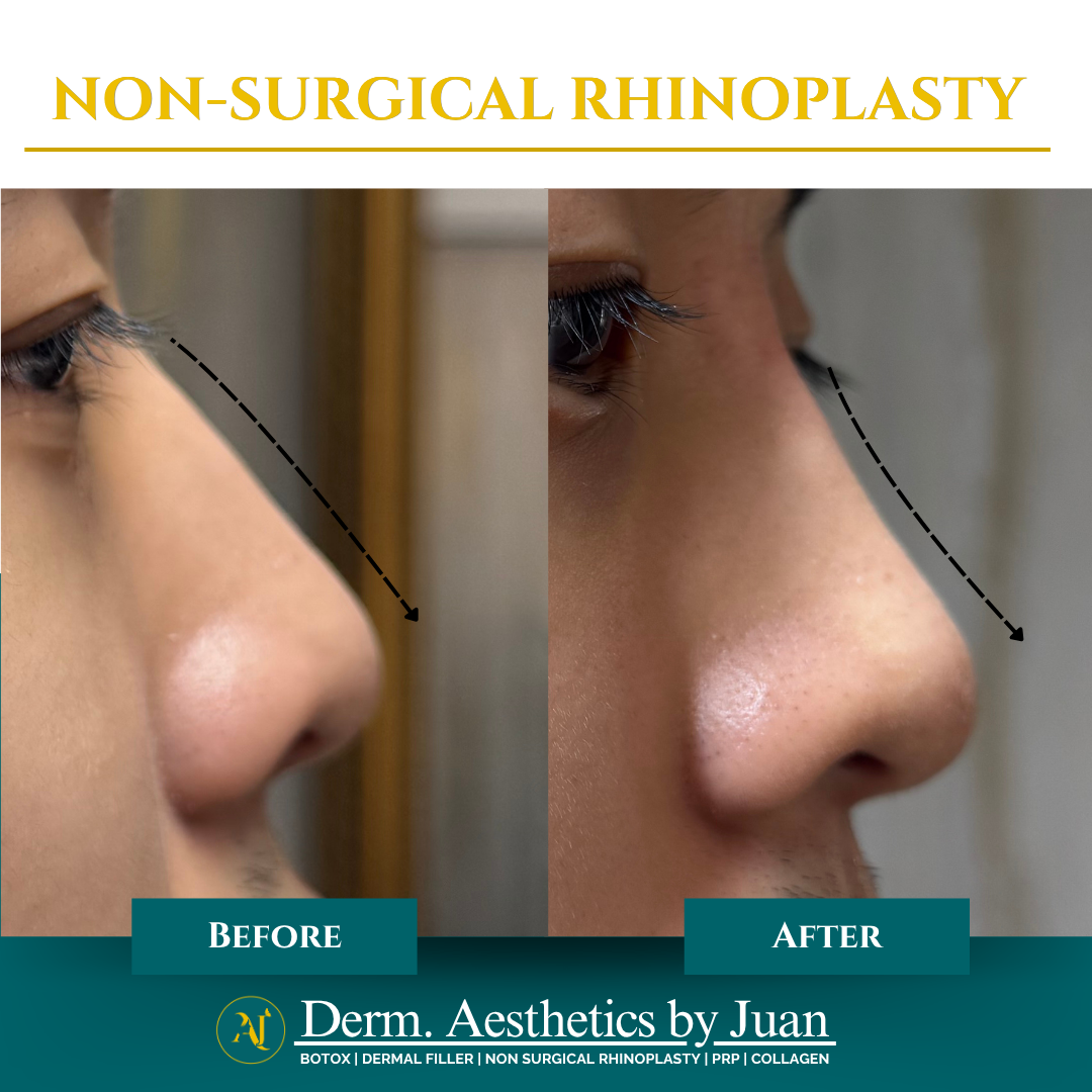 Non-surgical rhinoplasty before and after result