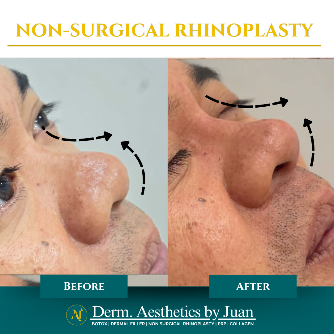 Non-surgical rhinoplasty before and after result