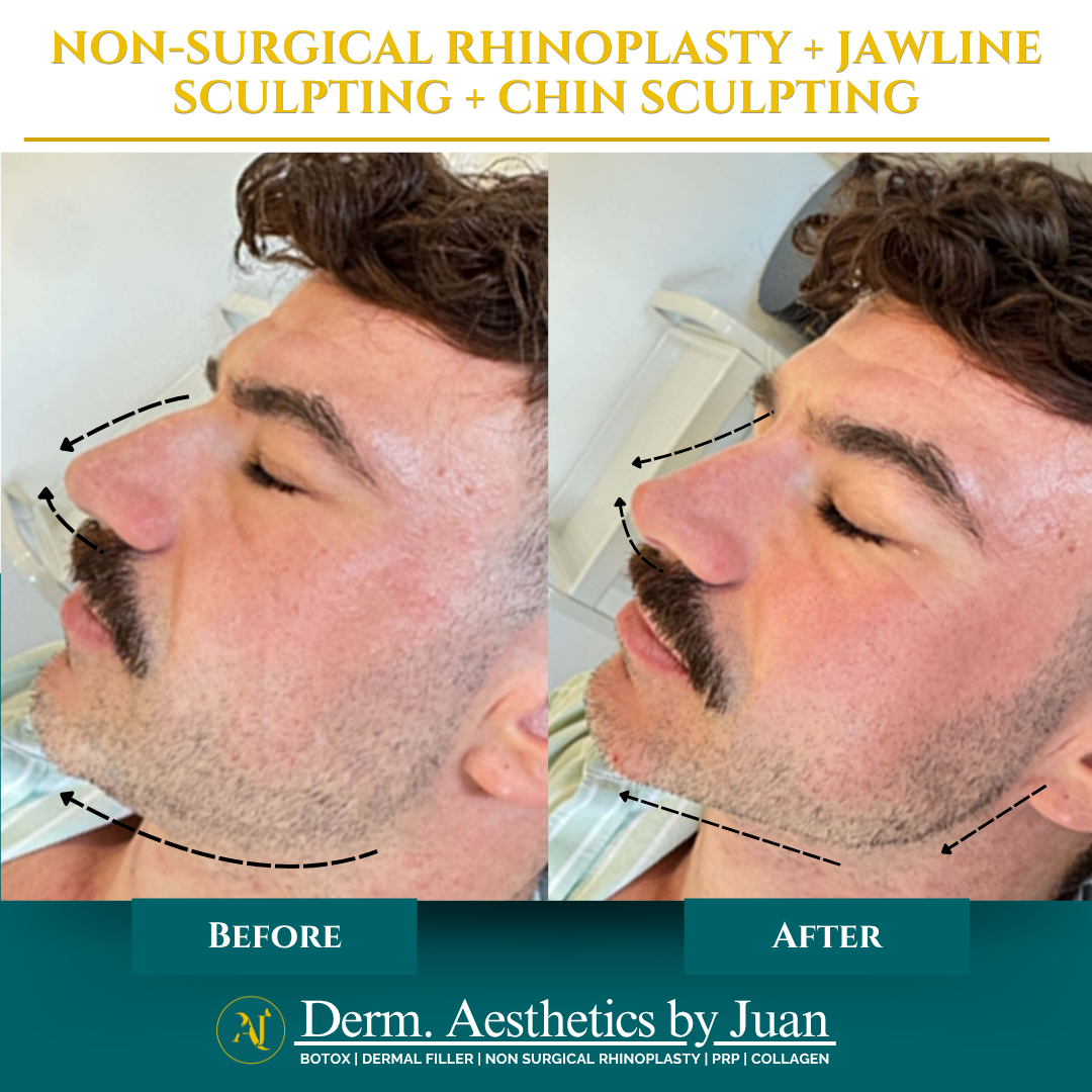 Non-surgical rhinoplasty before and after result