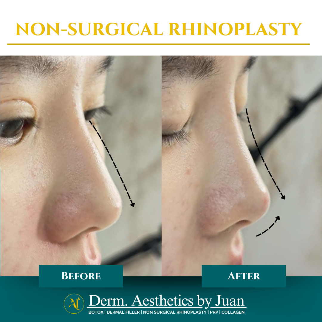 Non-surgical rhinoplasty before and after result