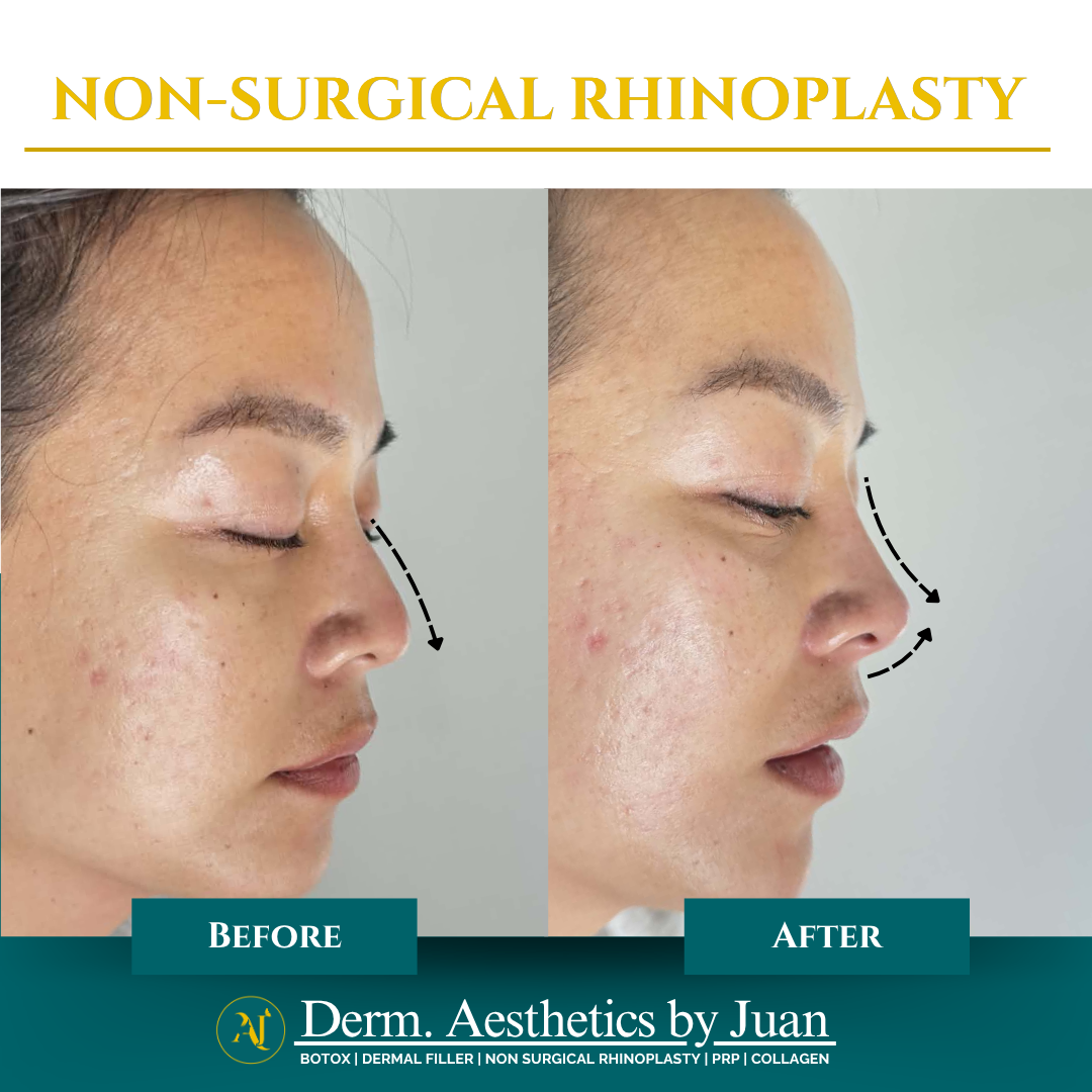 Non-surgical rhinoplasty before and after result