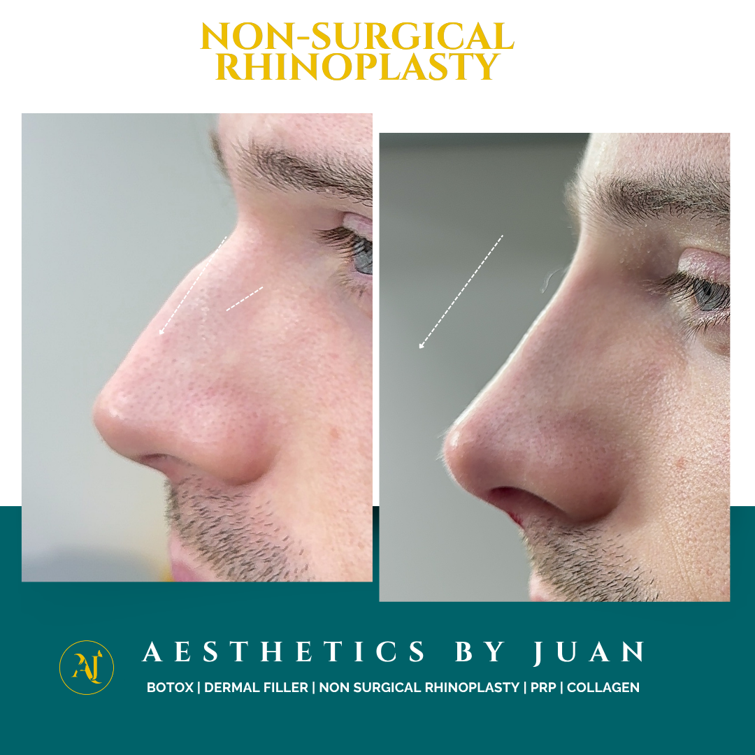 Non-surgical rhinoplasty before and after result