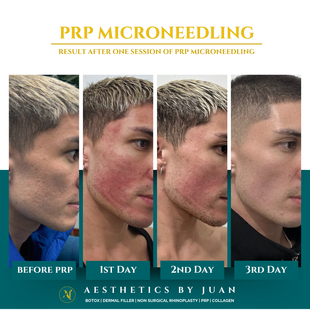 PRP microneedling result